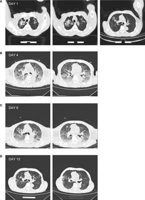 The diagnosis of leptospirosis complicated by pulmonary tuberculosis complemented by metagenomic next-generation sequencing: A case report